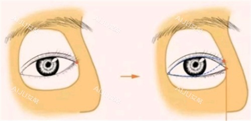 开外眼角手术设计图 开外眼角手术设计图