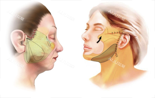 上海倪峰医拉皮手术面部脂肪组织区域圈画图