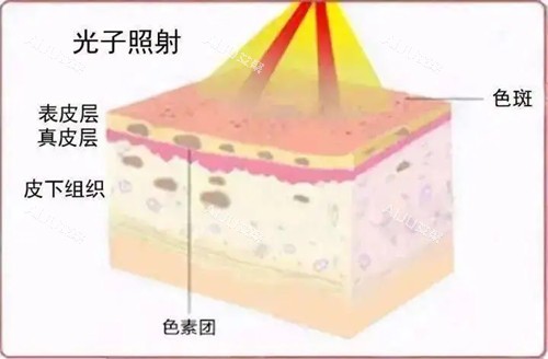光子嫩肤仪器医用有哪些品牌？哪种好用？OPT、AOPT、APT、DPL、BBL，附选择攻略
