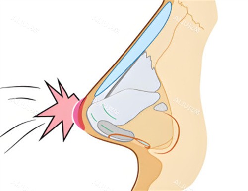 上海做鼻修复技术好的医生：徐怀河|范荣杰|许炎龙三位医生手术口碑及技术名扬在外！