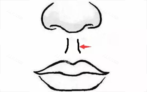 北京王晓健做人中缩短结果到底咋样？技术娴熟细节到位，术后自然修复快挺不错