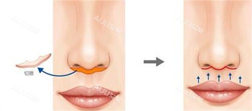 北京王晓健人中缩短改善卡通图展示