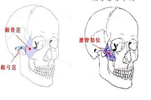 西安金一秀颧骨磨骨手术示意图 西安金一秀颧骨磨骨手术示意图