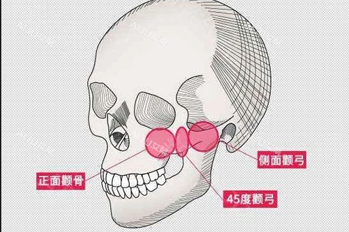 颧骨颧弓大概位置示意图 颧骨颧弓大概位置示意图