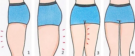 郑州覃泽大腿吸脂卡通图