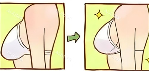 西安李高峰胸部缩小术前后对比动画图