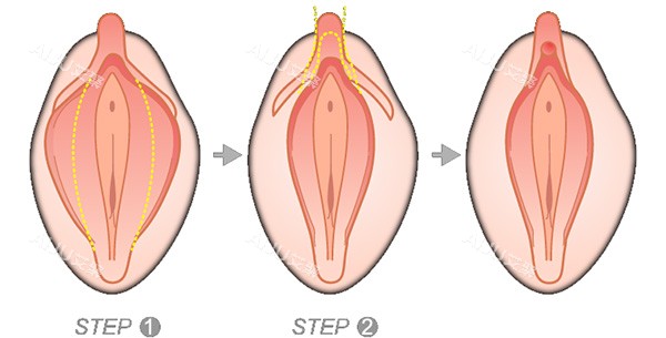 郑州张红歌手术费用是多少？阴唇整形3k+阴道紧缩3k+处女膜修复2k+私密漂红500+