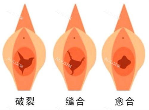 郑州张红歌处女膜修复手术前后对比图 郑州张红歌处女膜修复手术前后对比图