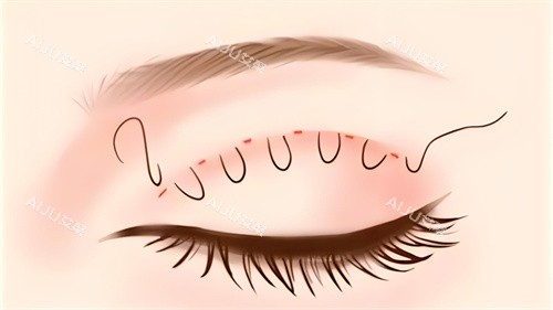 ​郑州王银玉割双眼皮好看吗？网评手法细腻审美好，做出来自然又好看