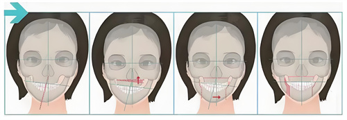 正颌手术手术步骤展示动画图