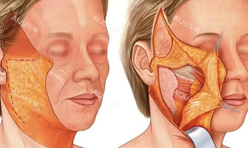 宋连成在哪个医院做拉皮？在郑州圣熙格兰，拉皮经验足|技术出色|结果显著