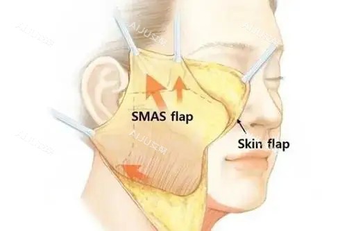 合肥华美赵辑医生面部拉皮技术好不好？备受网友推荐/医生拉皮技术娴熟/审美在线/成效显著