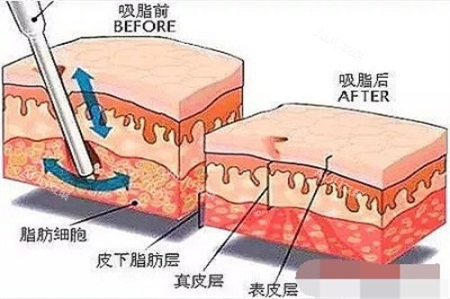 李奇军吸脂前后脂肪对比图
