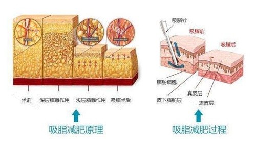 北京成铤吸脂减肥原理