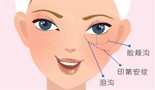 泪沟填充图