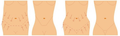 腹壁成形可改善的腰腹状态