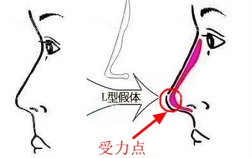 蔡德鹏L形隆鼻假体对比