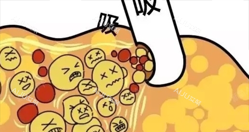 北京冯庆亮吸脂过程动画展示图