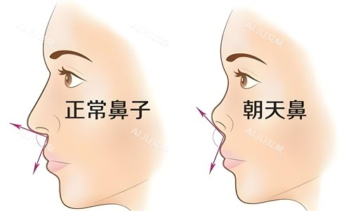 南京曹海峰正常鼻子与朝天鼻对比动画图