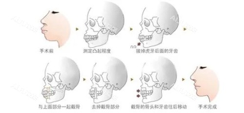 章建林正颌手术步骤图示