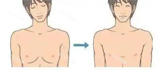 男性乳房发育吸脂后示意图