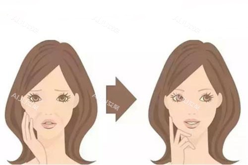 面部韧带卡通对比图