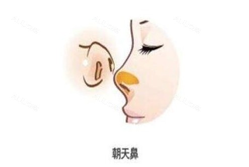 北京冯振科朝天鼻整形手术