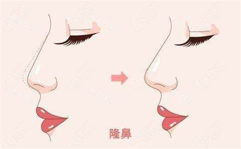 北京蔡德鹏隆鼻术图