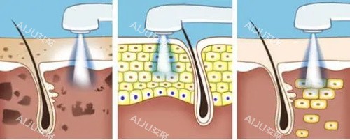 光子嫩肤的过程 光子嫩肤的过程