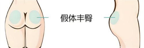 北京余恩旭假体丰臀手术