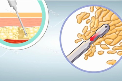 北京纯脂冯斌吸脂怎么样？数十年吸脂经验|平铺吸脂体验感好|术后修复快