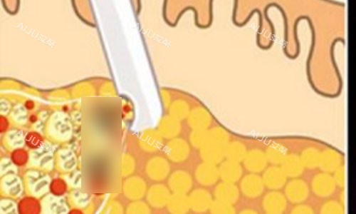 吸脂动画示意图 吸脂动画示意图