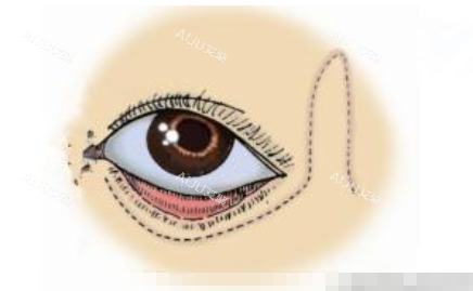 郑州贺洁医生专注眼部整形修复多年，擅长处理复杂眼袋与眼睑问题，备受信赖