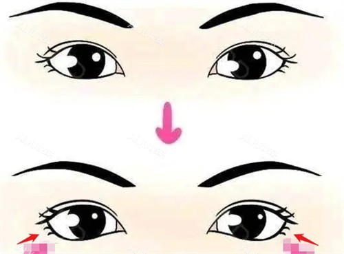 眼睑下至前后对比图.jpg 眼睑下至前后对比图.jpg