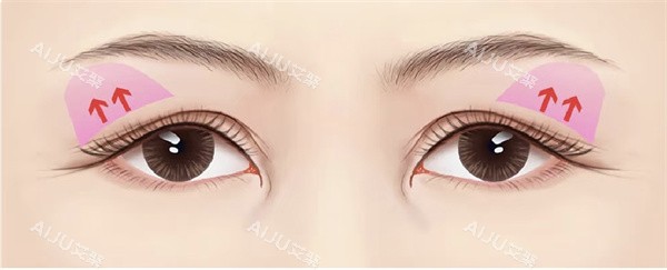 上眼睑松弛 上眼睑松弛