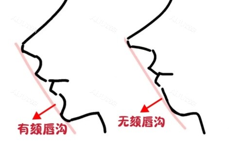 颏唇沟注射前后示意图