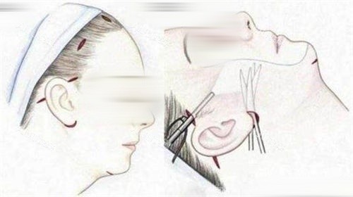 拉皮手术画线手术过程展示图.jpg