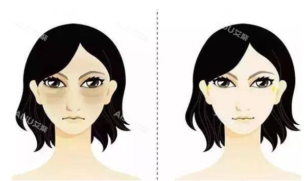泪沟黑眼圈前后对比示意图