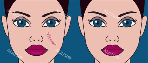 深圳刘纯源疤痕消除对比