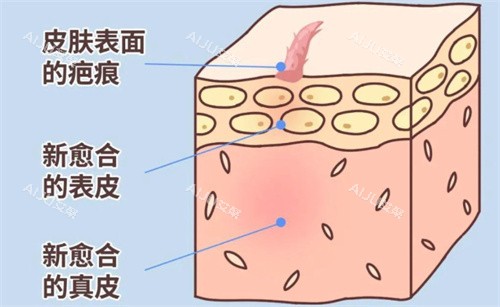 深圳刘纯源疤痕的形成过程