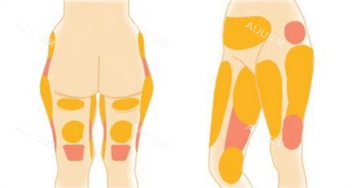 深圳黄奔医生腿部吸脂部位