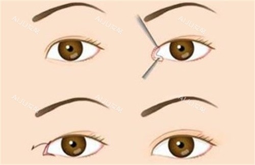 上海王衡健双眼皮修复哪里好？精细修复疤痕肉条、宽改窄自然、失败术例挽救率高