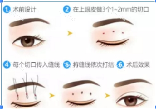 上海王衡健埋线双眼皮流程图
