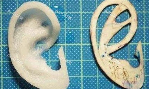 上海张群医生Medpor人工支架耳再造手术