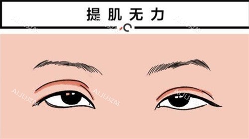 提肌无力