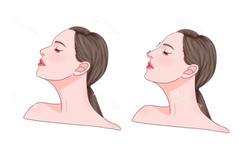 深圳富华田芳斌鼻整形术后示意图