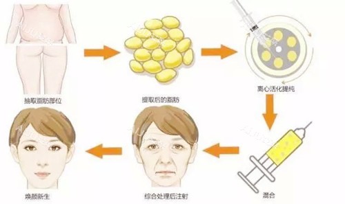 深圳石东文医生自体脂肪面部填充