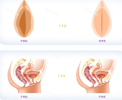 深圳陈志茹私密整形前后对比图