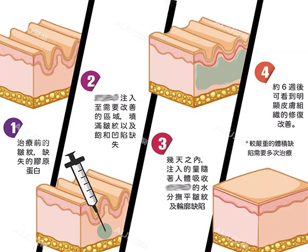 左旋乳酸PLLA清秀针注射照片