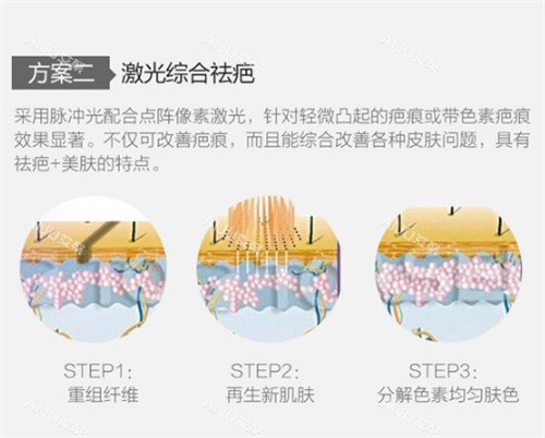 激光祛疤图示